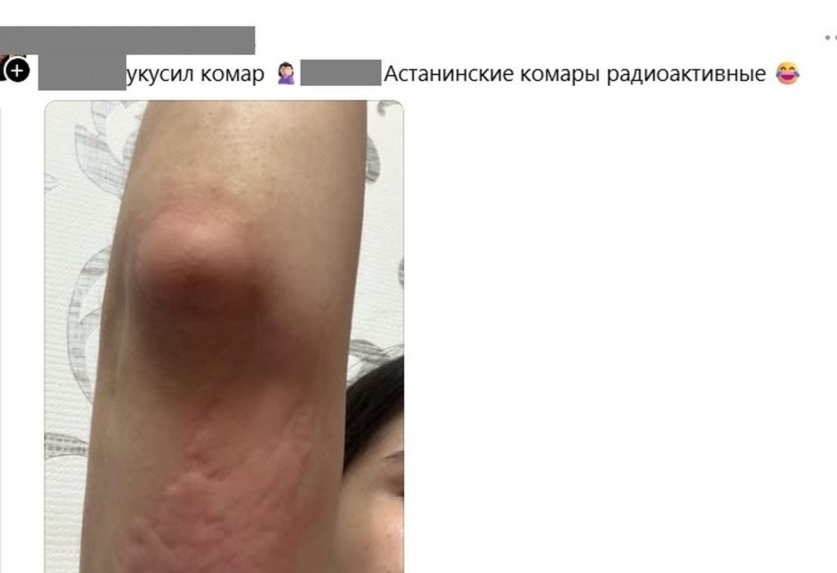 аллергия 